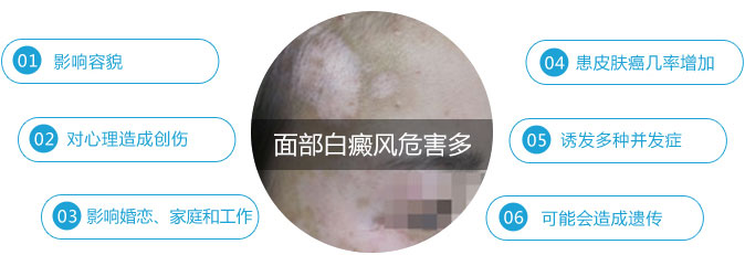 面部白癜风危害