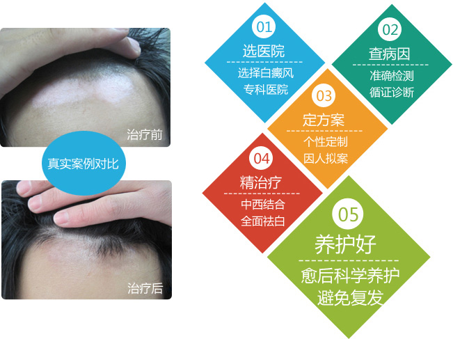 面部白癜风治疗